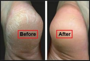 Remedies For Cracked Heels