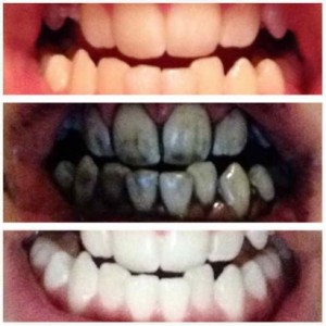 Whitening Your Teeth