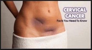 Signs of Cervical Cancer