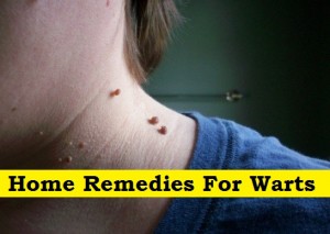 Remedies For Warts