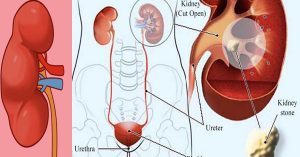 signs-and-symptoms-of-chronic-kidney-disease